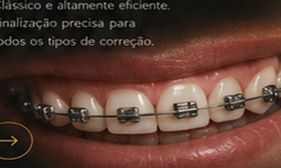 Aparelho ortodôntico metálico